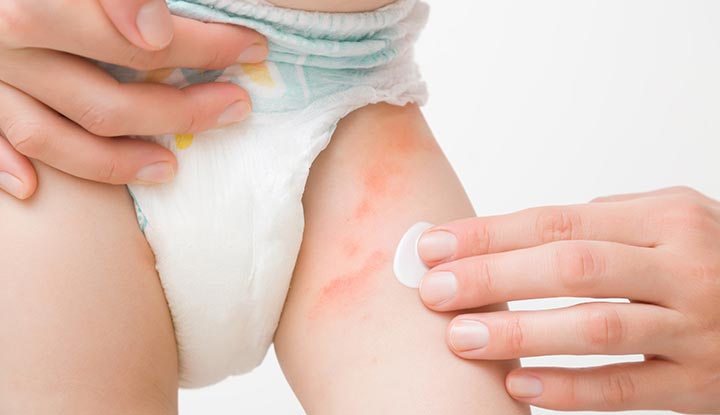 Yeast Diaper Rash: Effective Treatments & Soothing Home Care